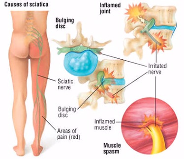 Are you or your partner suffering from sciatic pain? 🫠 As per