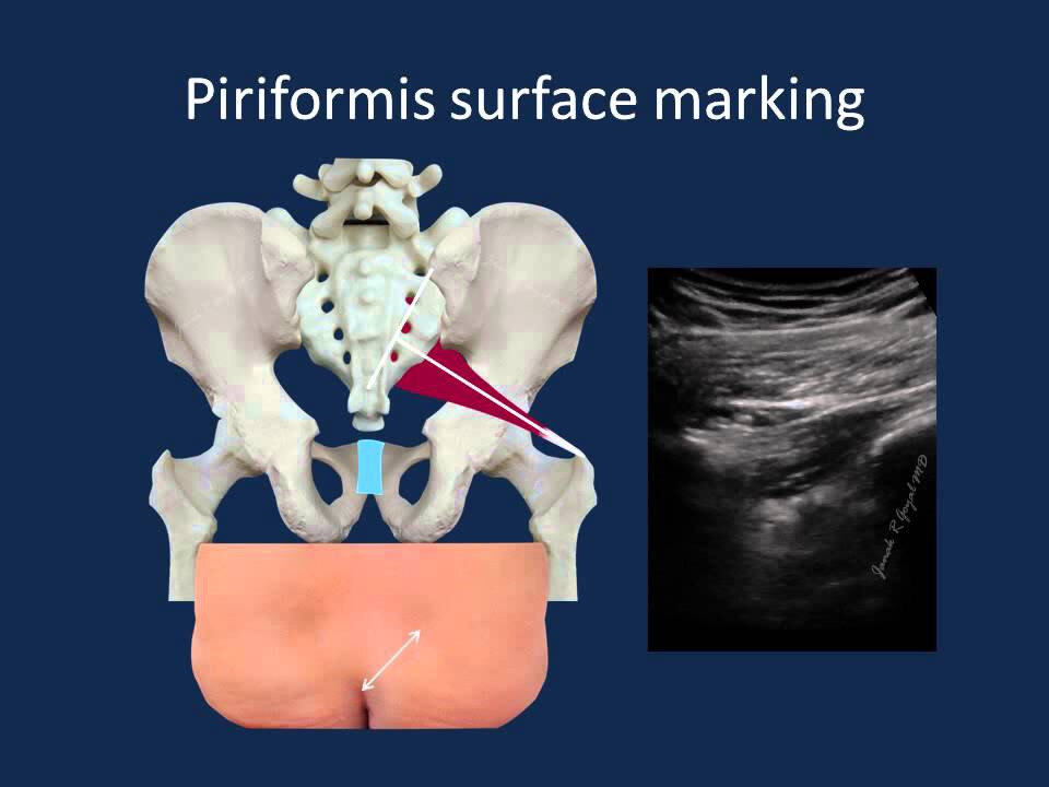 Surface marking of PIRIFORMIS muscle