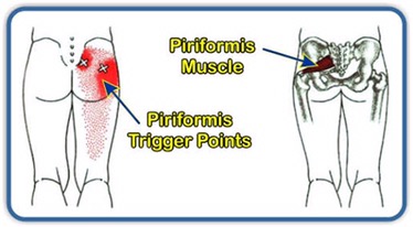 PIRIFORMIS muscle trigger pain points