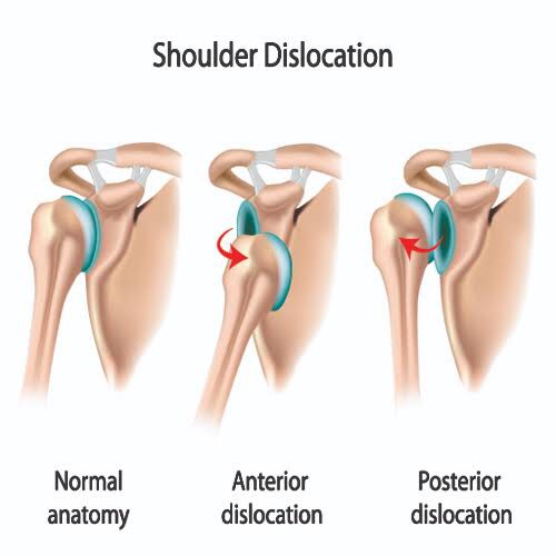 shoulder dislocation