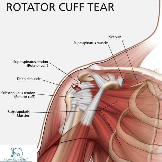 rotator cuff tear