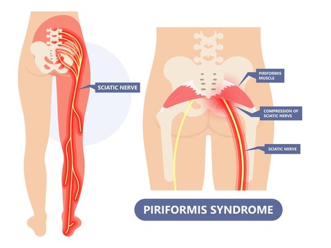 Piriformis Syndrome