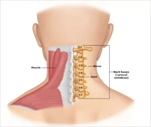 Cervical Spondylosis - Physioheal Physiotherapy