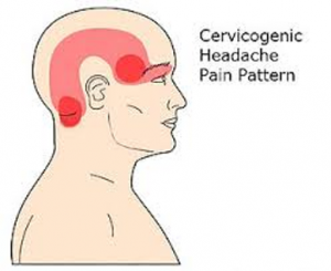Cervicogenic Headaches - Physioheal Physiotherapy