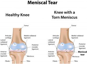 Meniscus Tear - Physioheal Physiotherapy