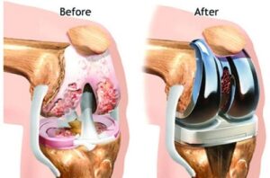 Total Knee Replacement - Physioheal Physiotherapy