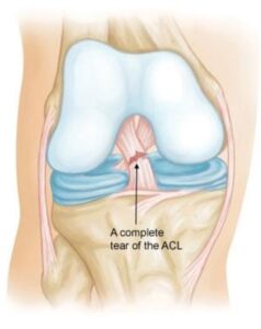 ACL Injury - Physioheal Physiotherapy