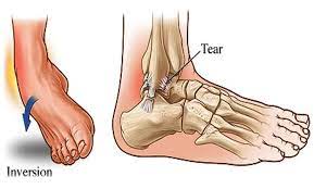 Ankle Sprain Physiotherapy - PhysioHeal Best Physiotherapy Clinic