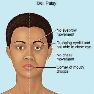 Physiotherapy and Bell's Palsy Treatment