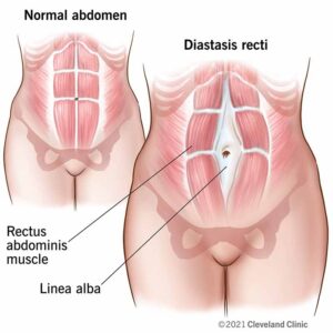 Diastasis Recti - PhysioHeal Best Physiotherapy Clinic in Gurgaon