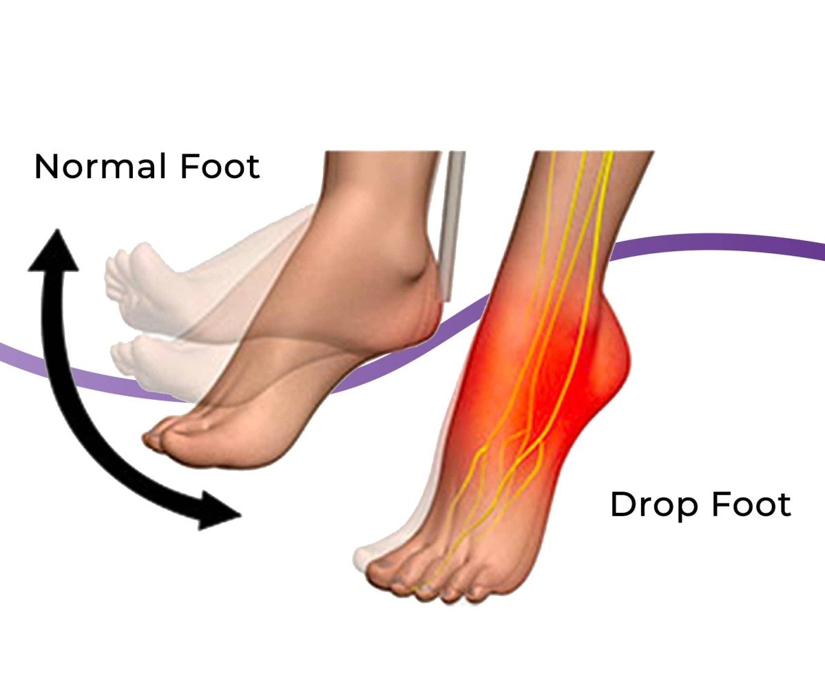 Foot Drop Treatment in Gurgaon  Foot Drop Physiotherapy Gurgaon