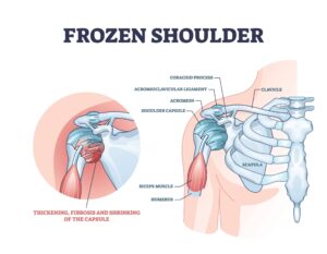 Frozen Shoulder - Physioheal Physiotherapy