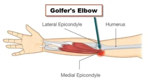Golfer Elbow - Physioheal Physiotherapy