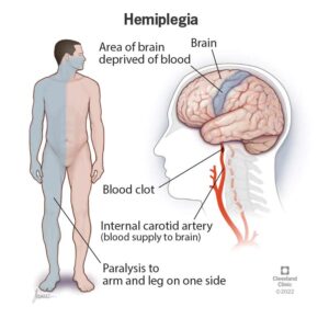 Hemiplegia physiotherapy treatment