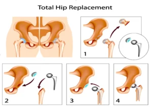 Hip Replacement Rehabilitation