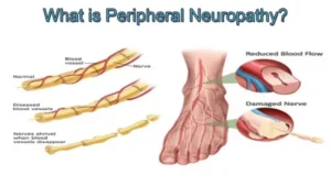 Neuropathy - Physioheal Physiotherapy