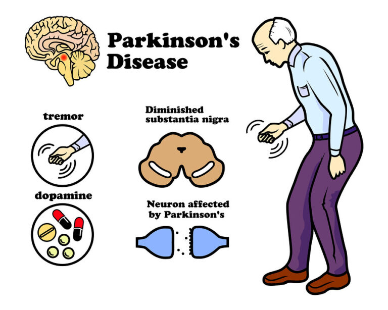 Parkinson Disease - PhysioHeal Best Physiotherapy Clinic In Gurgaon