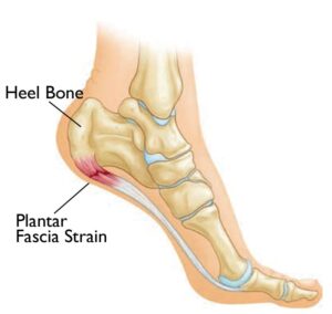 Plantar Fasciitis - Physioheal Physiotherapy