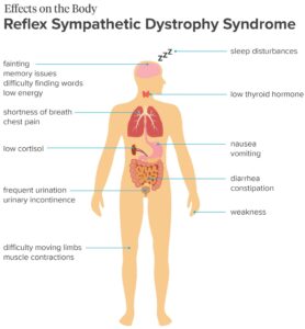 Reflex Sympathetic Dystrophy
