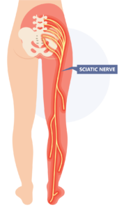 Sciatica - Physioheal Physiotherapy