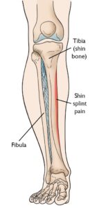Shin Splint - Physioheal Physiotherapy