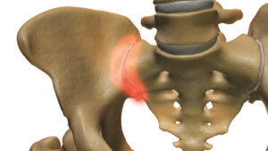 Sacroiliac Joint Disorders - Physioheal Physiotherapy