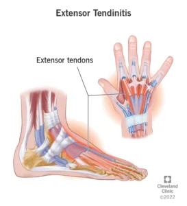Tendinitis - Physioheal Physiotherapy