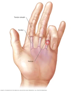 Trigger Finger - Physioheal Physiotherapy
