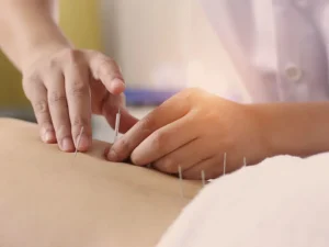 Acupuncture Physioheal Physiotherapy