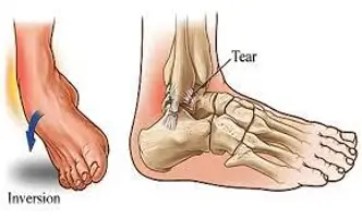 Ankle Sprain - Physioheal Physiotherapy