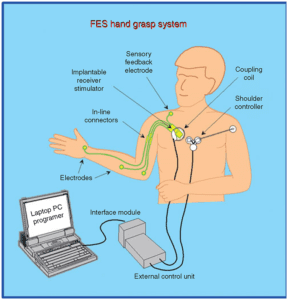 Functional Electrical Stimulation - Physioheal Physiotherapy