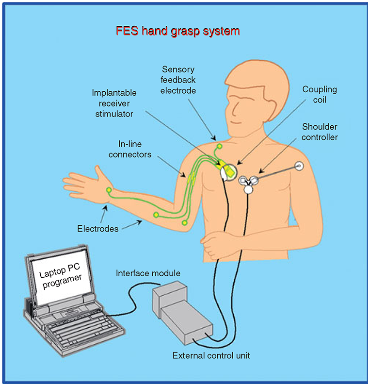Functional Electrical Stimulation (FES) - SCIRE Community