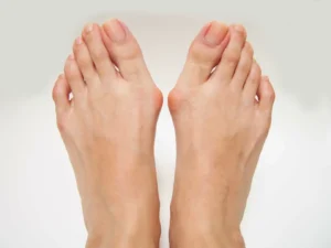 Bunions Physioheal Physiotherapy Treatment