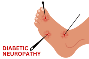 Diabetic Neuropathy Physioheal Physiotherapy